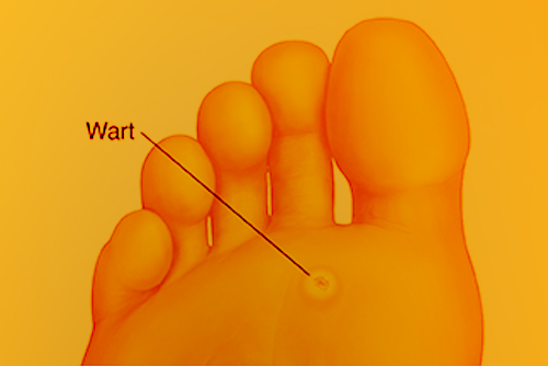 Plantar Warts