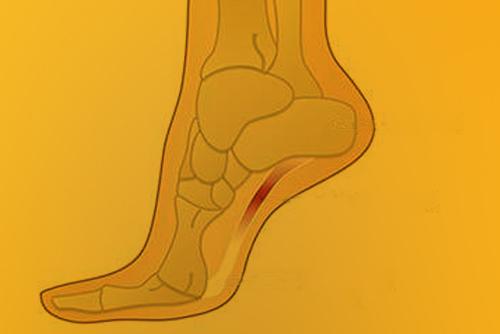 Heel and arch pain