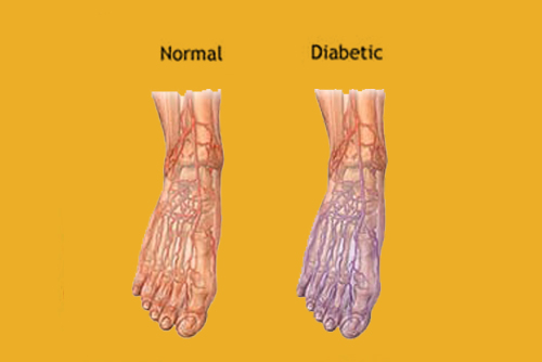 Diabetes Foot Disorder & Wound Care